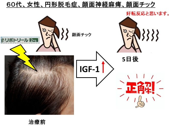 円形脱毛症　病院
